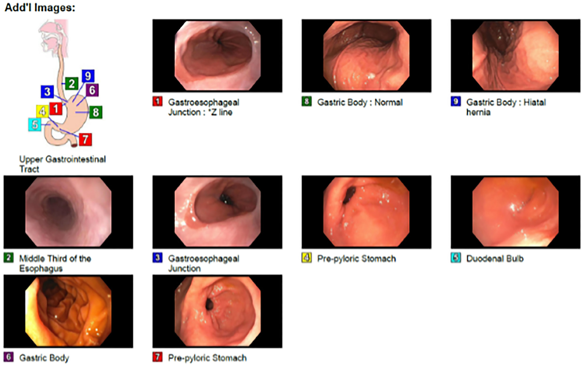 Rare Extraluminal Esophageal Cancer Invades Spine Despite Normal Endoscopy