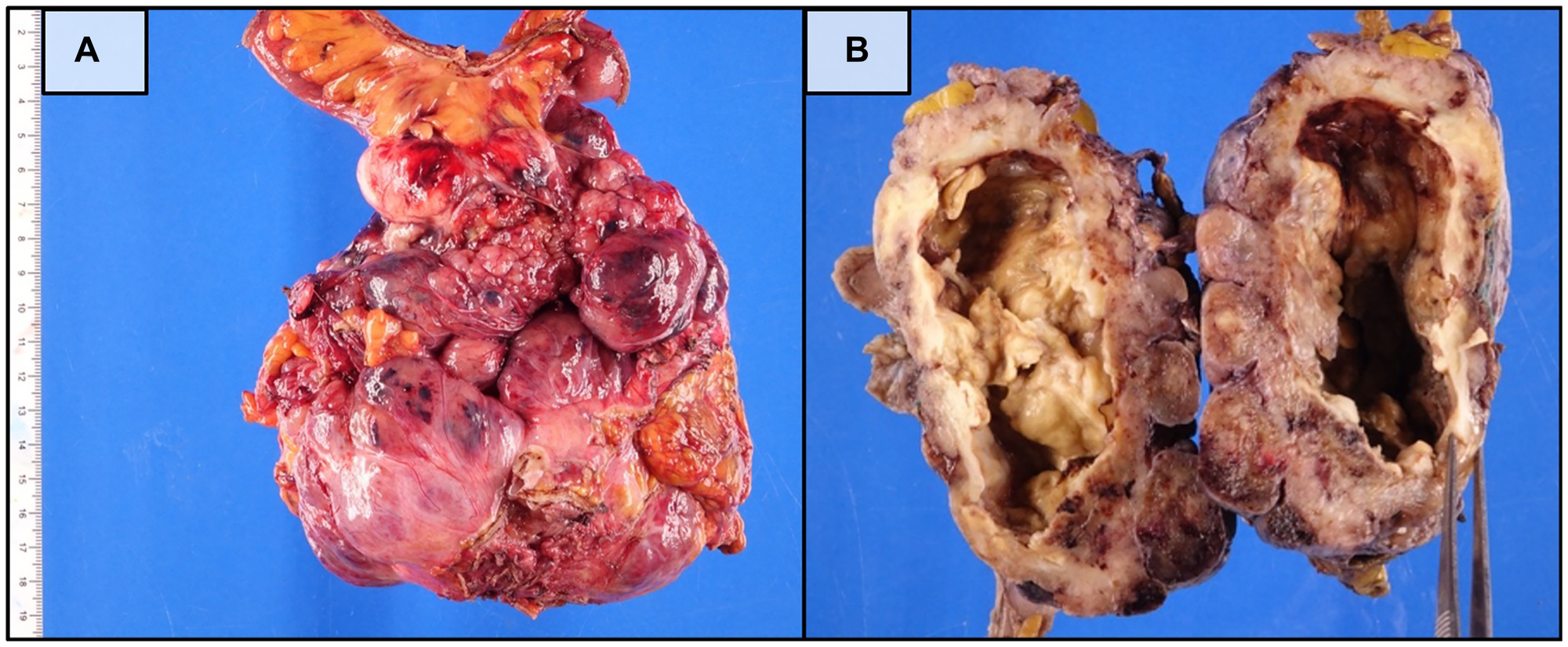 Rare Dual-Mutation GIST Responds to Targeted Therapy, Challenging Established Tumor Biology