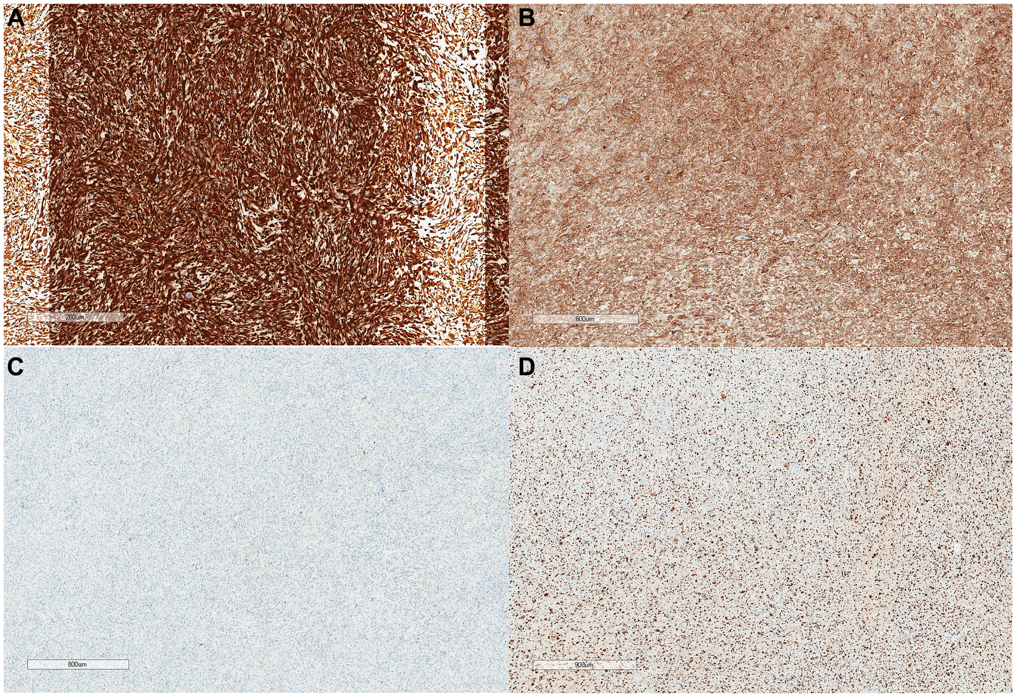 Rare Laryngeal Leiomyosarcoma Successfully Treated with Surgery and Adjuvant Chemotherapy