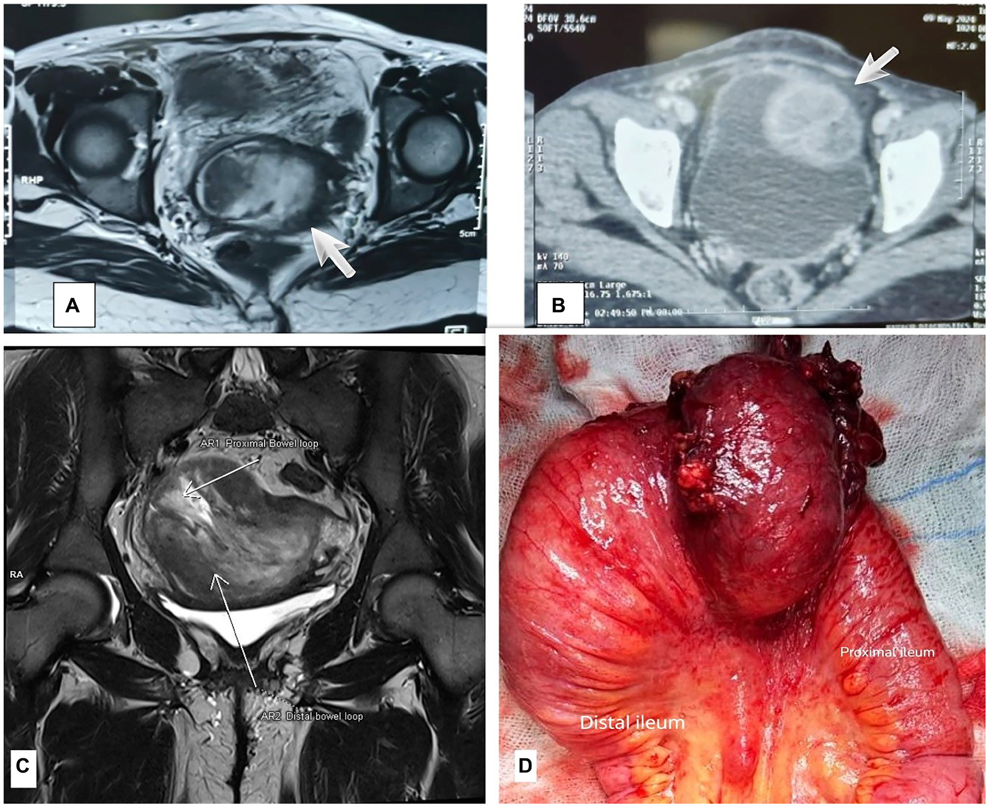 Rare Intestinal Tumor Mistaken for Intussusception Highlights Diagnostic Challenges in Young Woman
