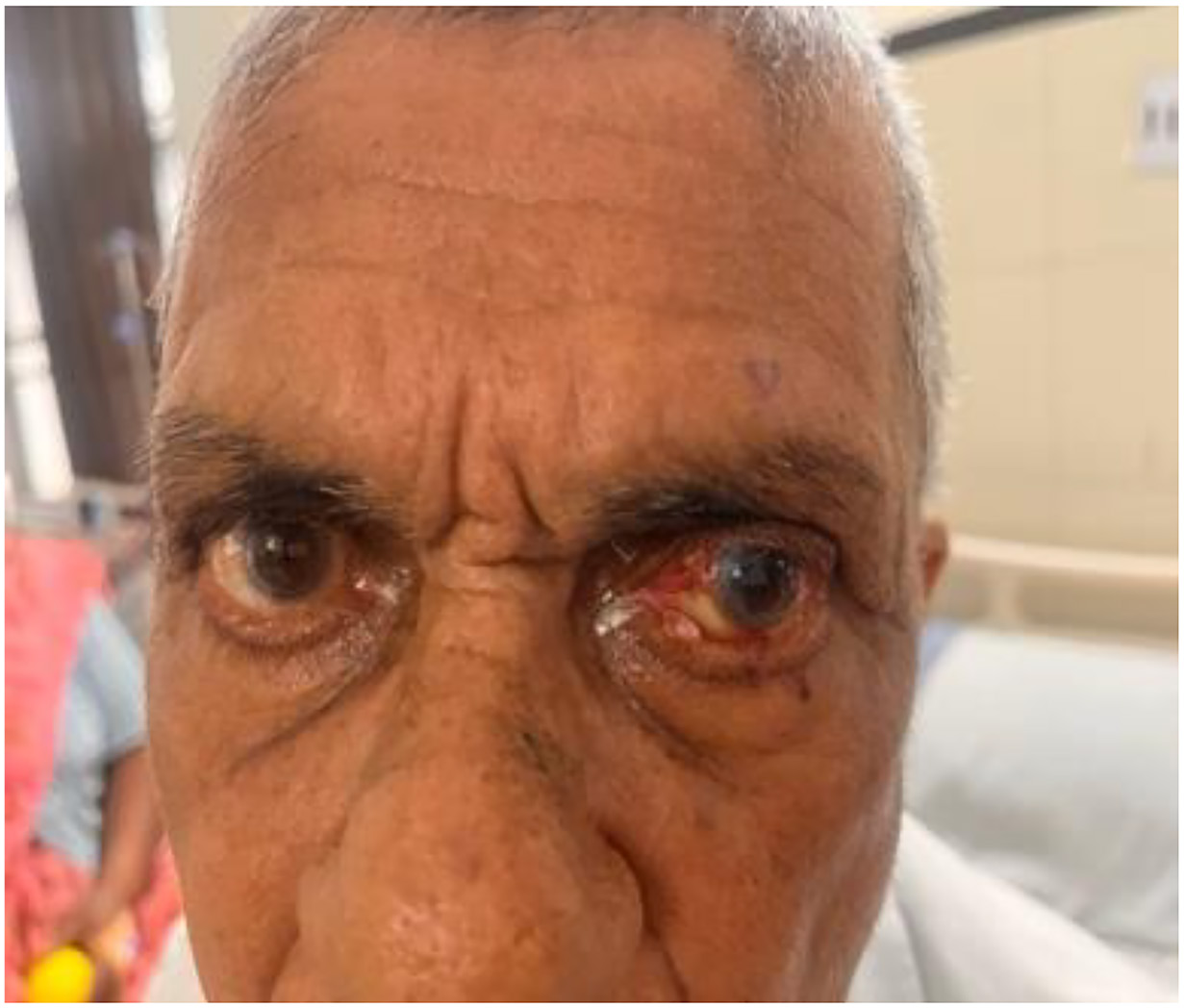 Rare Eyelid Tumor Highlights the Importance of Accurate Diagnosis and Pathological Evaluation