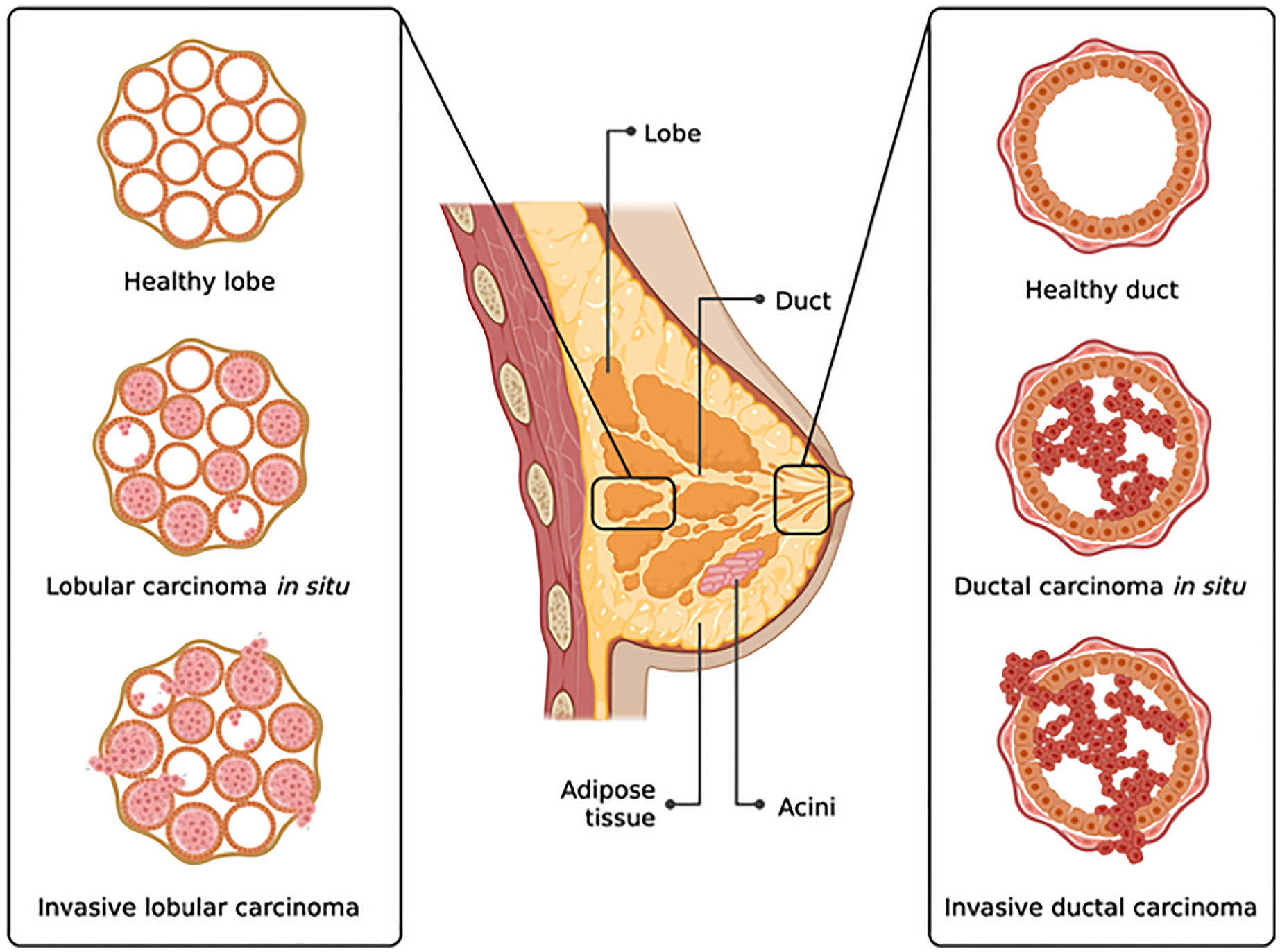 Artificial Intelligence Could Transform Breast Cancer Detection and Recurrence Prediction