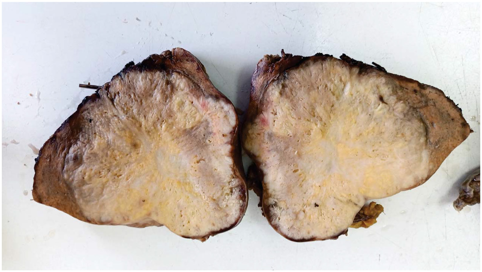 Rare Combined Liver Cancer Highlights Challenges in Diagnosis and Treatment