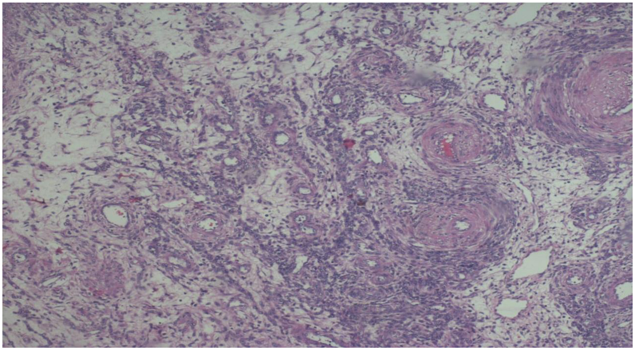 Rare Cervical Tumor Highlights Importance of Accurate Diagnosis in Women with Persistent Menorrhagia and Pelvic Pain